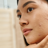 Blemish - Prone Skin